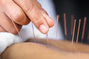 Acupuncture being performed at D'Vida Injury Clinic.