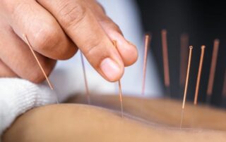 Acupuncture treatment for chronic pain at an injury clinic.