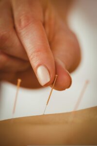 Acupuncture Points and Needles